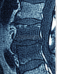 SPONDYLODISCITIS  MRI