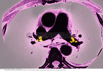 PULMONARY EMBOLISM  CT SCAN