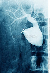 CHOLEDOCHAL CYST Imagerie