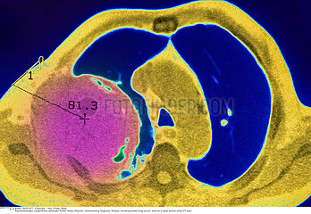 LUNG CANCER  CT SCAN
