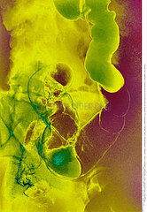 COLON CANCER  X-RAY Imagerie