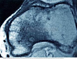 OSTEOID OSTEOMA MRI