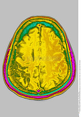 CEREBRAL ATROPHY  MRI