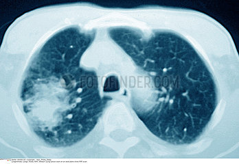 LUNG CANCER MRI