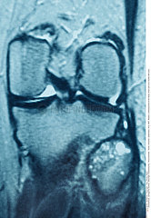 Osteosarcoma of the fibula