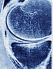 DAMAGED MENISCUS  MRI