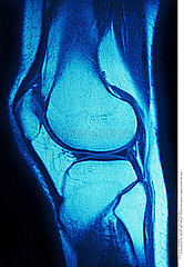 MRI normal knee
