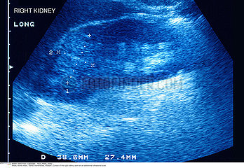 KIDNEY CANCER  SONOGRAPHY