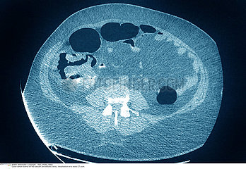 COLON CANCER CT SCAN