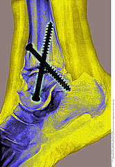 ANKLE OSTEOSYNTHESIS  X-RAY
