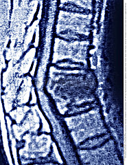 TUBERCULOSIS IN THE BONES  MRI