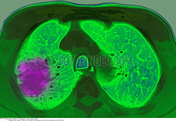 LUNG CANCER MRI