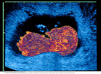 ULTRASOUND BIOMETRY OF THE FETUS