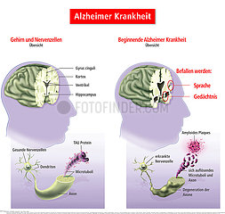 Alzheimer Krankheit