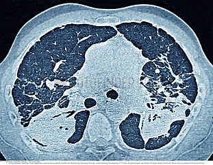 SILICOTIC LUNG  CT SCAN