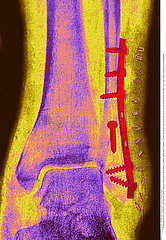 Osteosynthesis on a fracture of the fibula