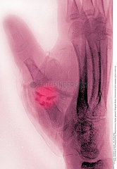 FRACTURED HAND  X-RAY