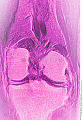 Normal knee MRI