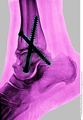 ANKLE OSTEOSYNTHESIS  X-RAY