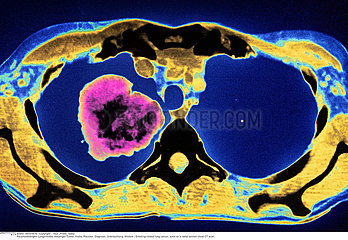 LUNG CANCER  CT SCAN