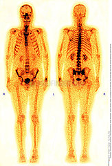 WHOLE BODY SCINTISCANNER Imagerie