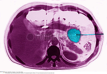 PANCREATIC CYST  PUNCTURE Imagerie