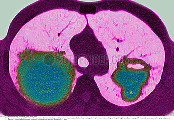 WEGENER'S DISEASE  CT SCAN