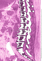 VERTEBRAL OSTEOARTHRITIS  CT-SCAN