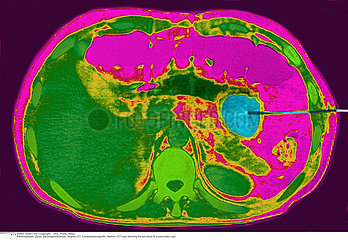 PANCREATIC CYST  PUNCTURE Imagerie