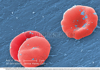 SICKLE CELL ANEMIA Imagerie