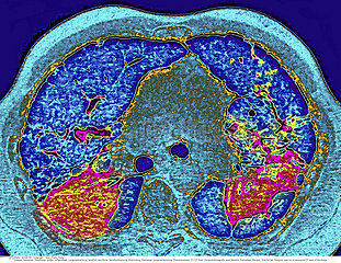 SILICOTIC LUNG  CT SCAN