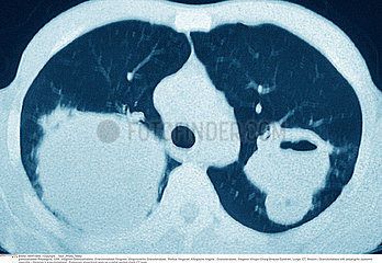 WEGENER'S DISEASE  CT SCAN