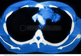 PULMONARY TUBERCULOSIS  CT-SCAN