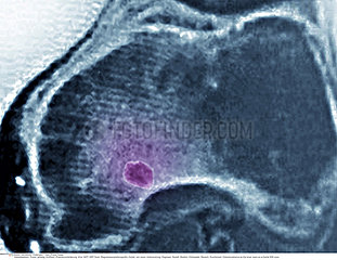 OSTEOID OSTEOMA MRI