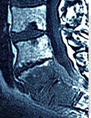 OSTEITIS  MRI