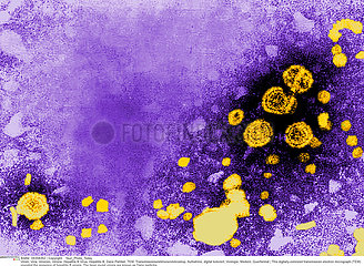 HEPATITIS B VIRUS Imagerie