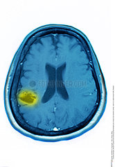 CEREBRAL ATROPHY  MRI