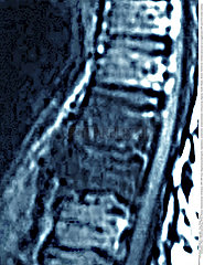 OSSEOUS EDEMA MRI