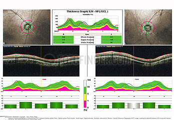 OPTICAL COHERENCE TOMOGRAPHY