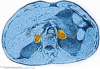 ADRENAL GLAND  CT SCAN Imagerie