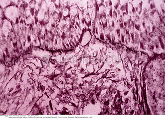 CANCER OF THE UTERUS  HISTOLOGY