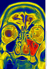 SINUSITIS MRI