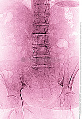 VERTEBRAL OSTEOARTHRITIS  X-RAY