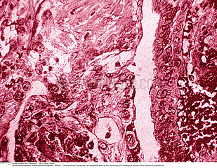 CANCER OF THE UTERUS  HISTOLOGY