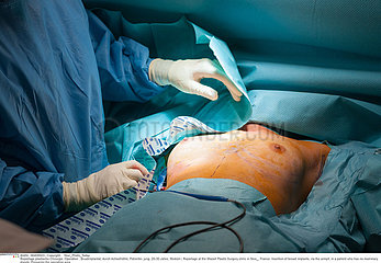 PLASTIC SURGERY ON A BREAST