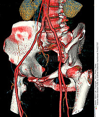 Iliac arteries