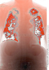 Pulmonary metastasis