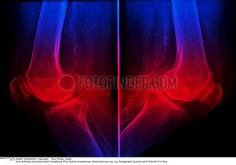 Knee arthrosis