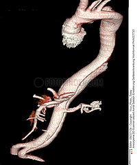 Dissecting aneurism of the aorta
