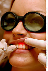 Dental laser